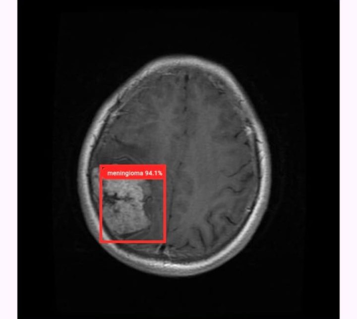 Brain Tumor Detection using YOLO v11